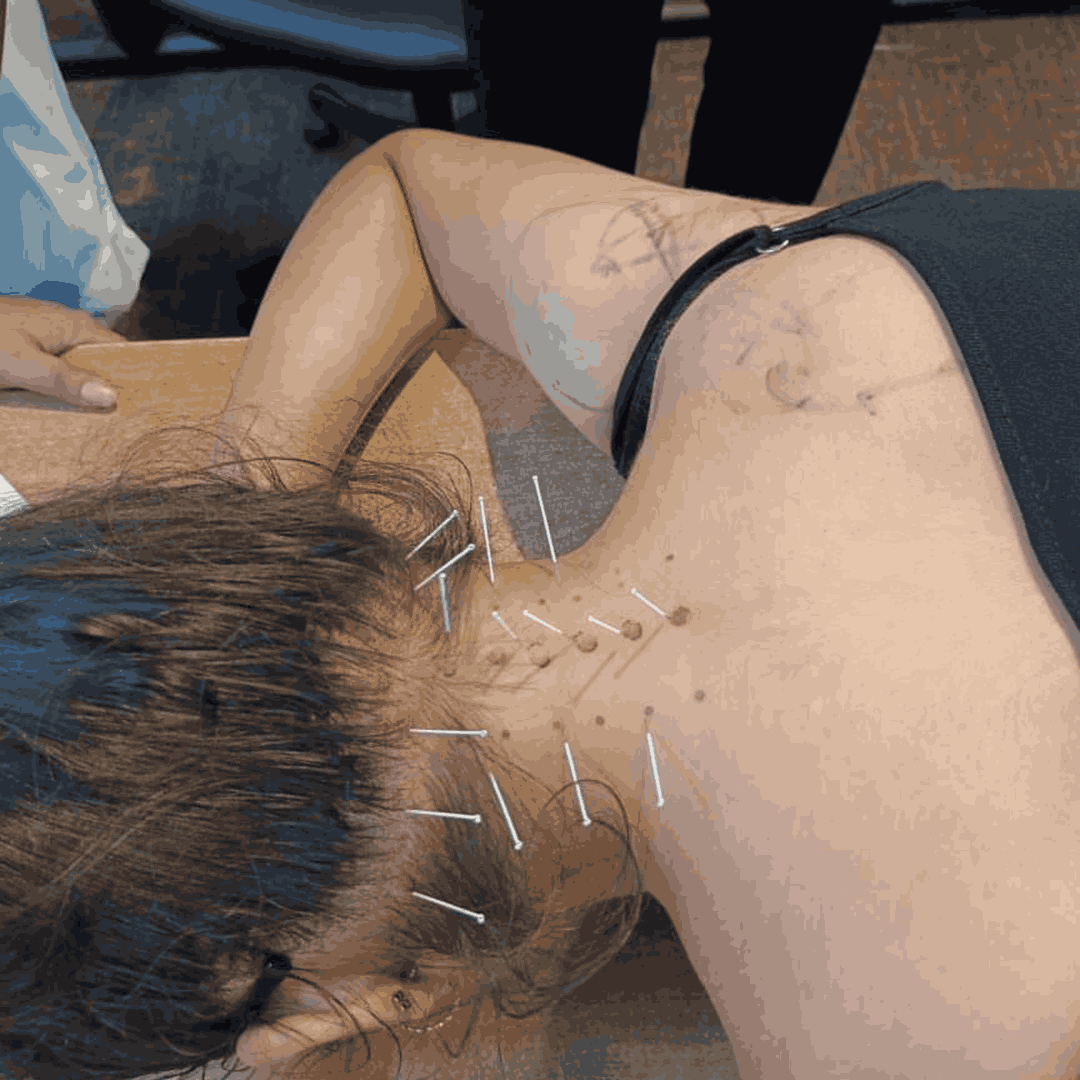 workshop-on-dry-needling (1)